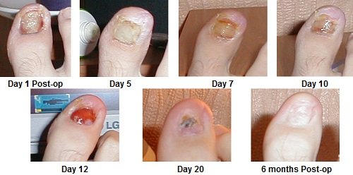 Ingrown Toenail Treatment Aka Unguis Incarnatus