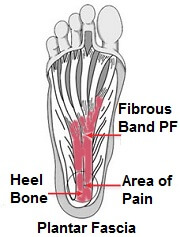 Plantar Fasciitis Symptoms, Diagnosis & Treatment