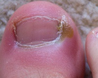 How to Treat Yellow Toenails