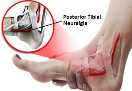 Tarsal Tunnel Syndrome Causes Symptoms Treatment