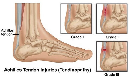 achilles tendon pain in foot
