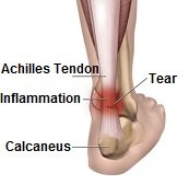 Achilles Tendonitis Treatment & Recovery