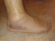 pain on outside of foot