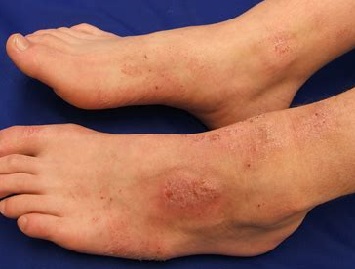 Are your feet itchy? You may have Athletes Feet. - South Devon