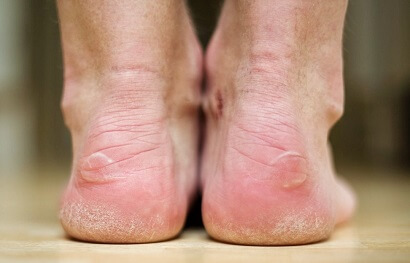 Blisters On Feet \u0026 Toes: Causes 