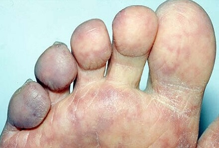 Blue Toe Syndrome Foot Pain 
