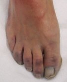 Blue Toe Syndrome: Symptoms, Causes & Treatment