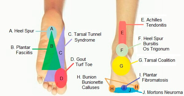 Bottom Of Foot Pain Diagnosis Diagram 