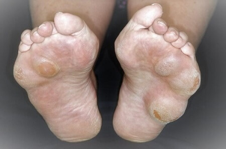 Lumps and Bumps on your Feet? - Burlington Sports Therapy