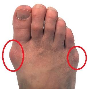 Got Big Toe Bumps and Lumps? Here's 5 Things You Need to Know