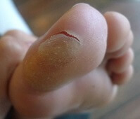 dead skin on bottom of big toe
