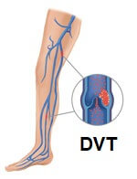 A DVT classically presents with pain, redness, swelling and heat in the calf.  Medical attention should be sought immediately