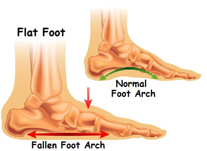 arch pain in foot from walking