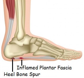 heel arch pain causes