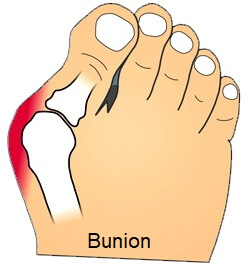 Pain On Outside Of Foot: Symptoms, Diagnosis & Treatment