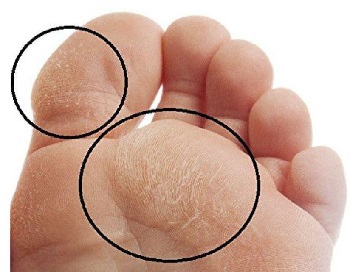 painful dead skin on foot