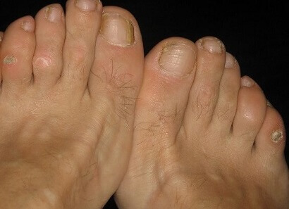 callus on toe knuckle