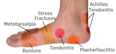 pain in the foot near heel