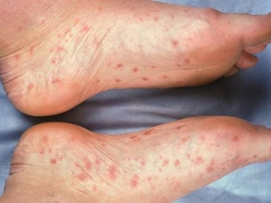 painful rash on lower leg