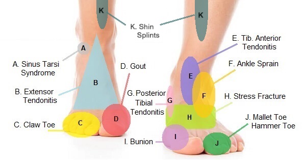 Causes and Treatment of Heel Pain - Dr. John Chrabuszcz » OrthoGeorgia