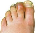 Blisters On Feet & Toes: Causes, Symptoms & Treatment