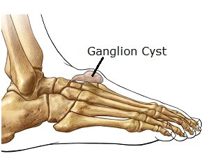 Pain Top of Foot: Causes, Symptoms Treatment