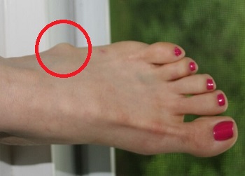 Ganglion cyst on foot: Pictures, cause, symptoms, and treatment