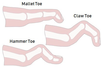 Hammer Toe or Mallet Toe, Causes, Signs and Symptoms, Diagnosis