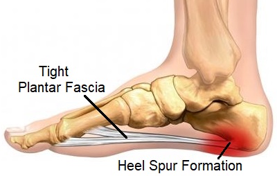 Bone spurs of the heel of foot defined and treatments