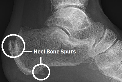 Heel Spur - Symptoms, Causes, Treatment & Exercises