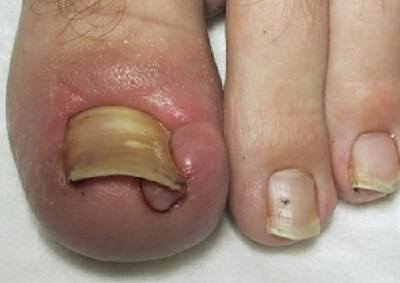 ingrown toenail healing