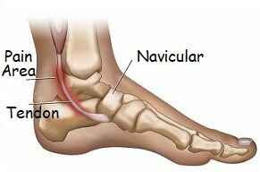 pain on one side of heel