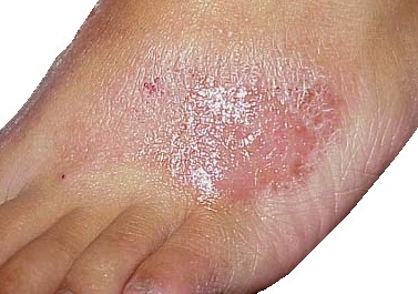 my foot is dry itchy and peeling