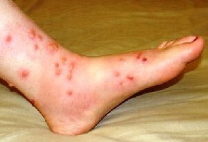 Foot Eczema Causes Symptoms Treatment Foot Pain Explored