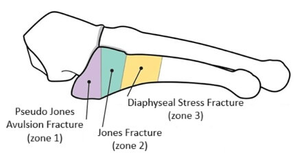 Pseudo Jones Fracture Symptoms & Treatment