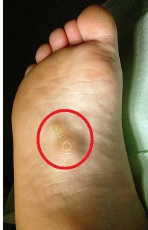 painful spot on sole of foot