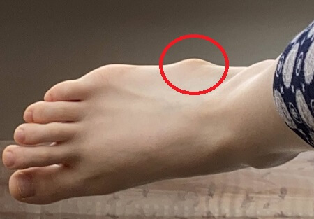 Lump On Side Of Foot 