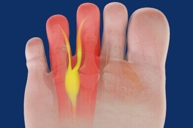 Morton's Neuroma: Causes, Symptoms & Treatment