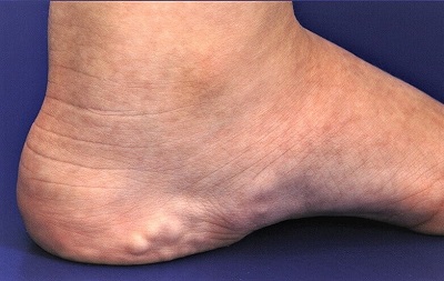 Piezogenic Papules Lumps On Side Of Foot 