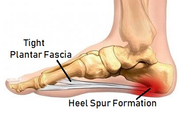 bone spur heel causes