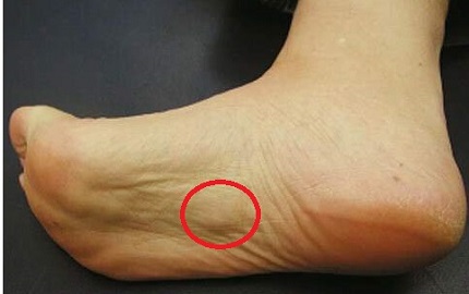 painful sore on bottom of foot