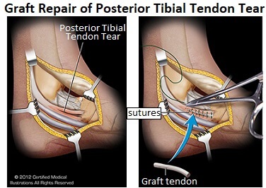 tibialis posterior tendon insertion