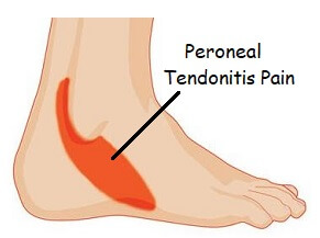 outside of sole of foot pain