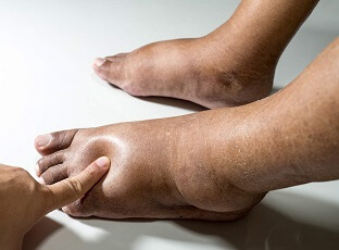 Swollen Feet And Ankles Link 