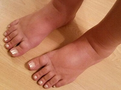 swollen feet from shoes