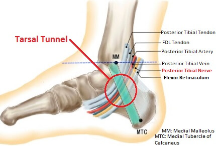 Tarsal Tunnel Syndrome: Causes, Symptoms & Treatment
