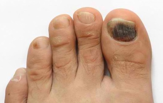 Toenail Problems: Causes, Symptoms, and Treatments