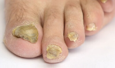 Thickened and Overgrown Nails  Nail Surgery Specialist Clinic In London