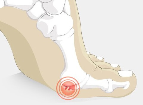 Reasons for Pain in the Big Toe