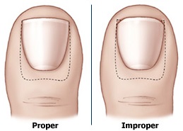 Ingrown Toenail Treatment aka Unguis Incarnatus